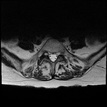 What is a synovial cyst?
